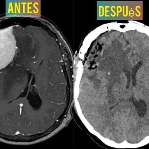 Neurocirujano salva vida